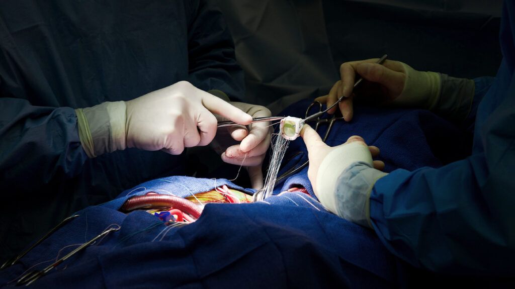 Cardiac Surgery